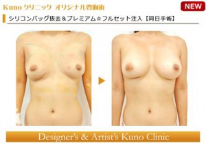 Kunoクリニック　シリコンバッグ抜去＆再生豊胸　6